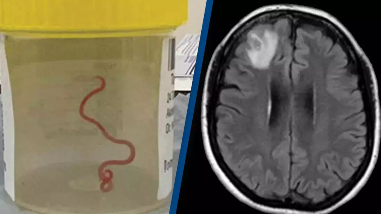 Living parasitic worm removed from woman's brain for the first time ever