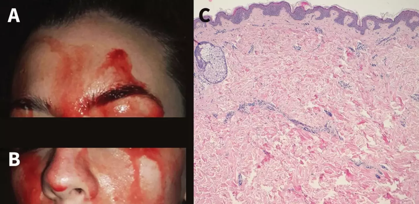 On the left, an image of the woman's face during a bleeding episode. On the right, an image of the woman's skin under a microscope, which showed normal tissue. (CMAJ)
