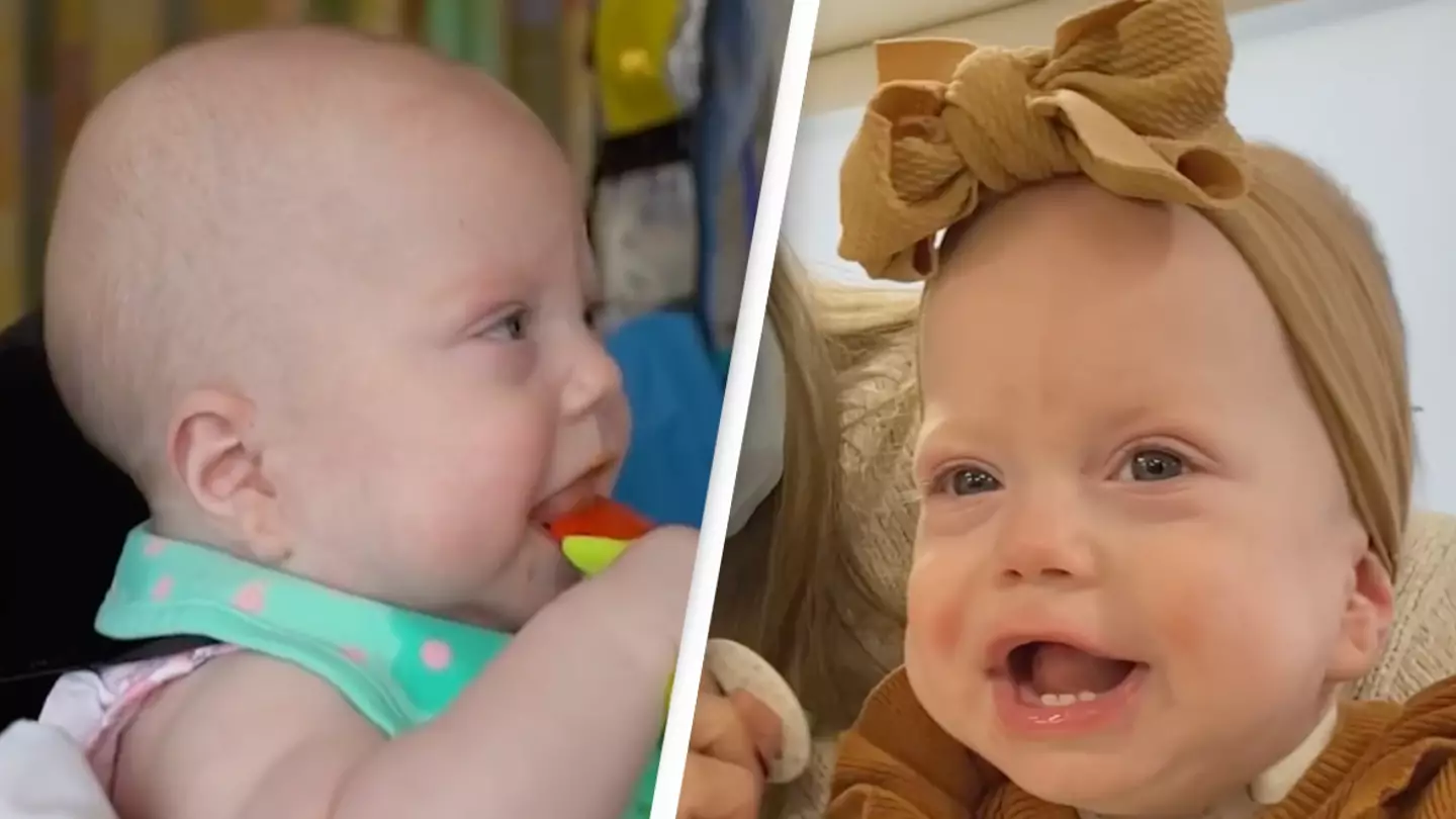Baby with rare condition is born with adult sized tongue