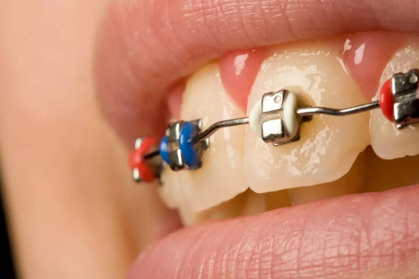 Our ancestors didn't need braces, according to the fossil record. (Getty stock image)