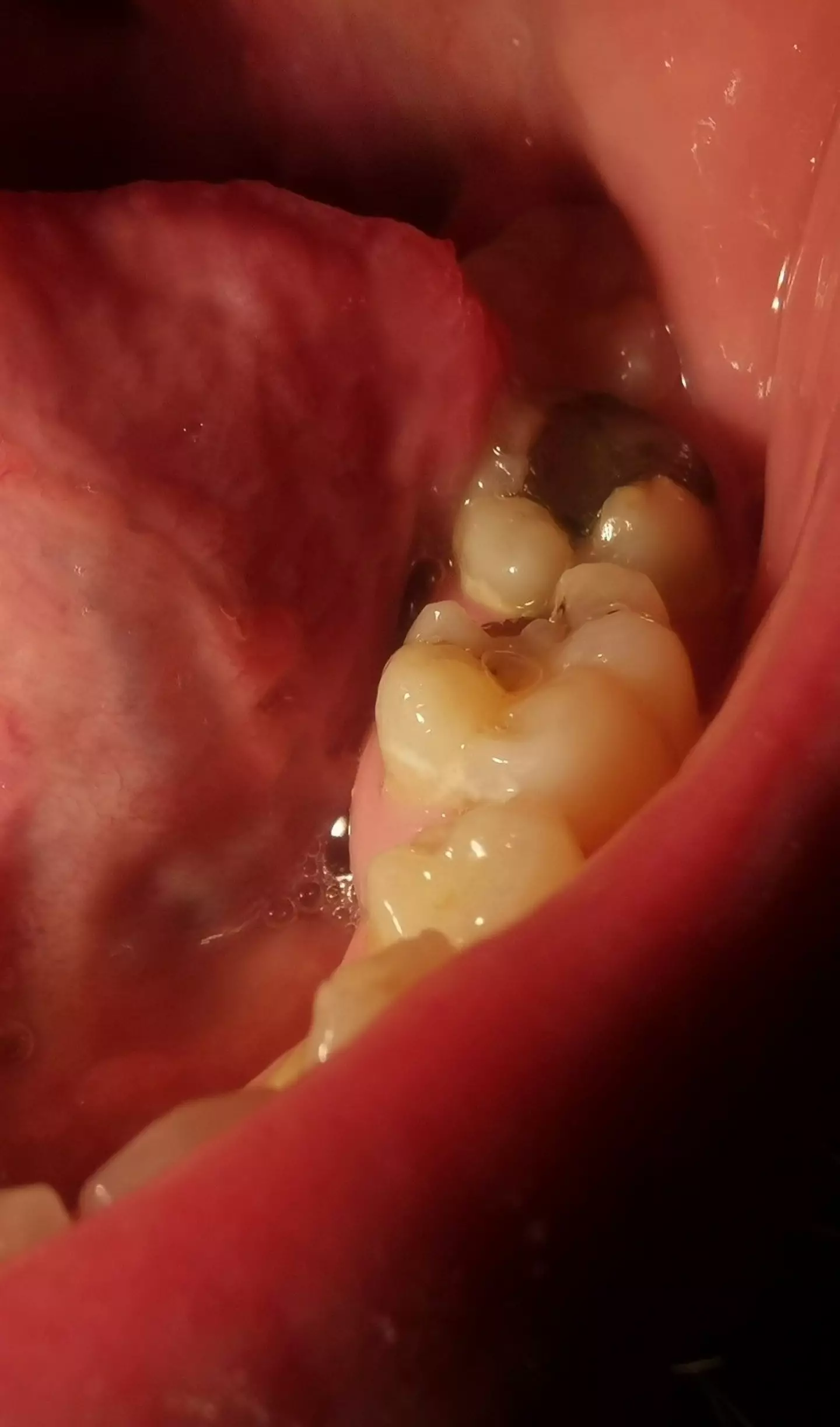 Carlton Hill's teeth. (Media Wales)