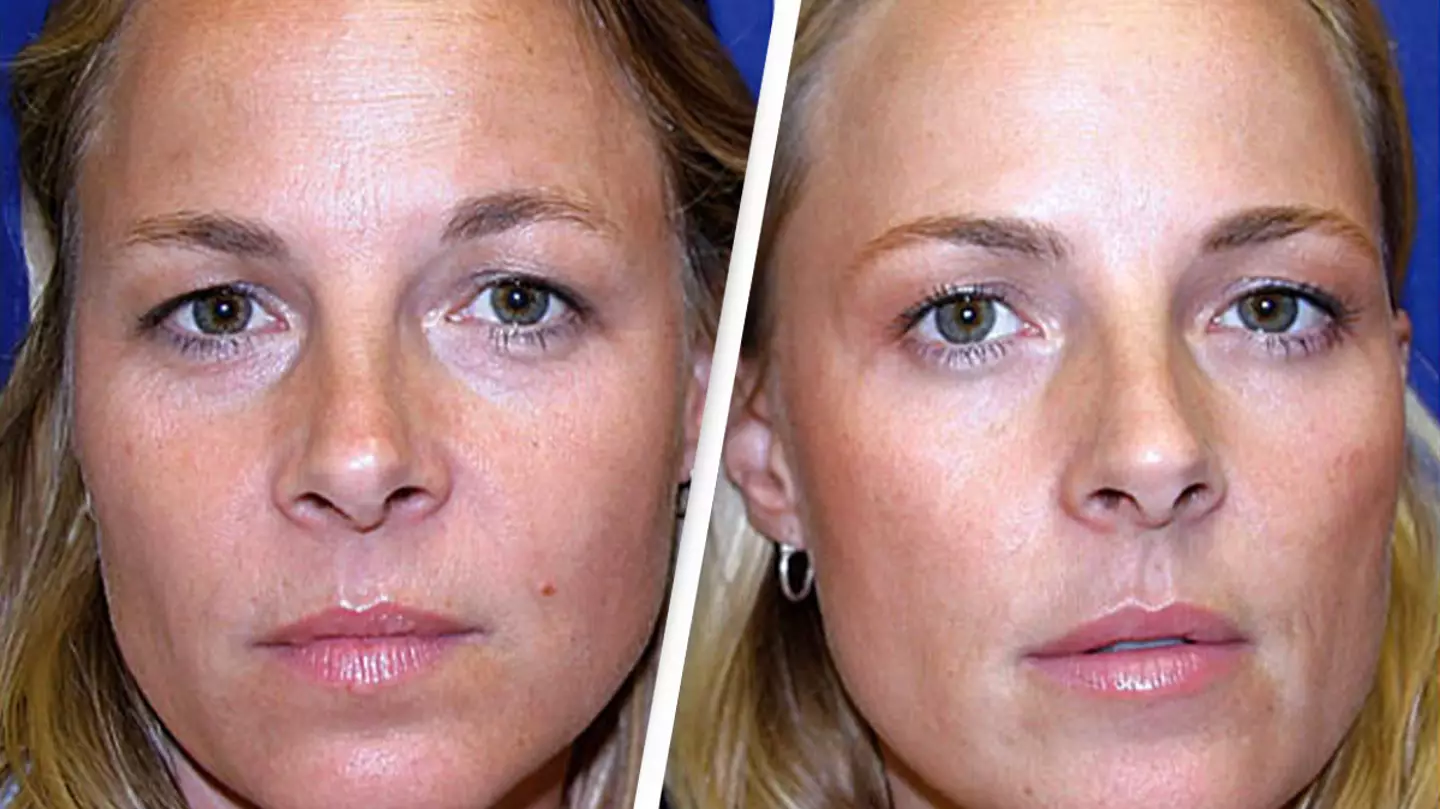Doctor explains long-term effects as identical twins share startling results after one used botox while the other didn't