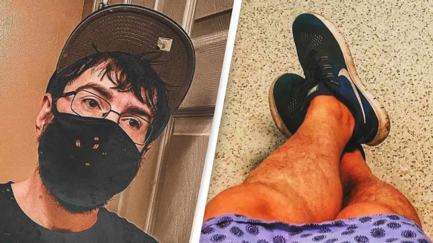 Man with the 'world's smallest penis' reveals surprising thing his doctor told him about his manhood