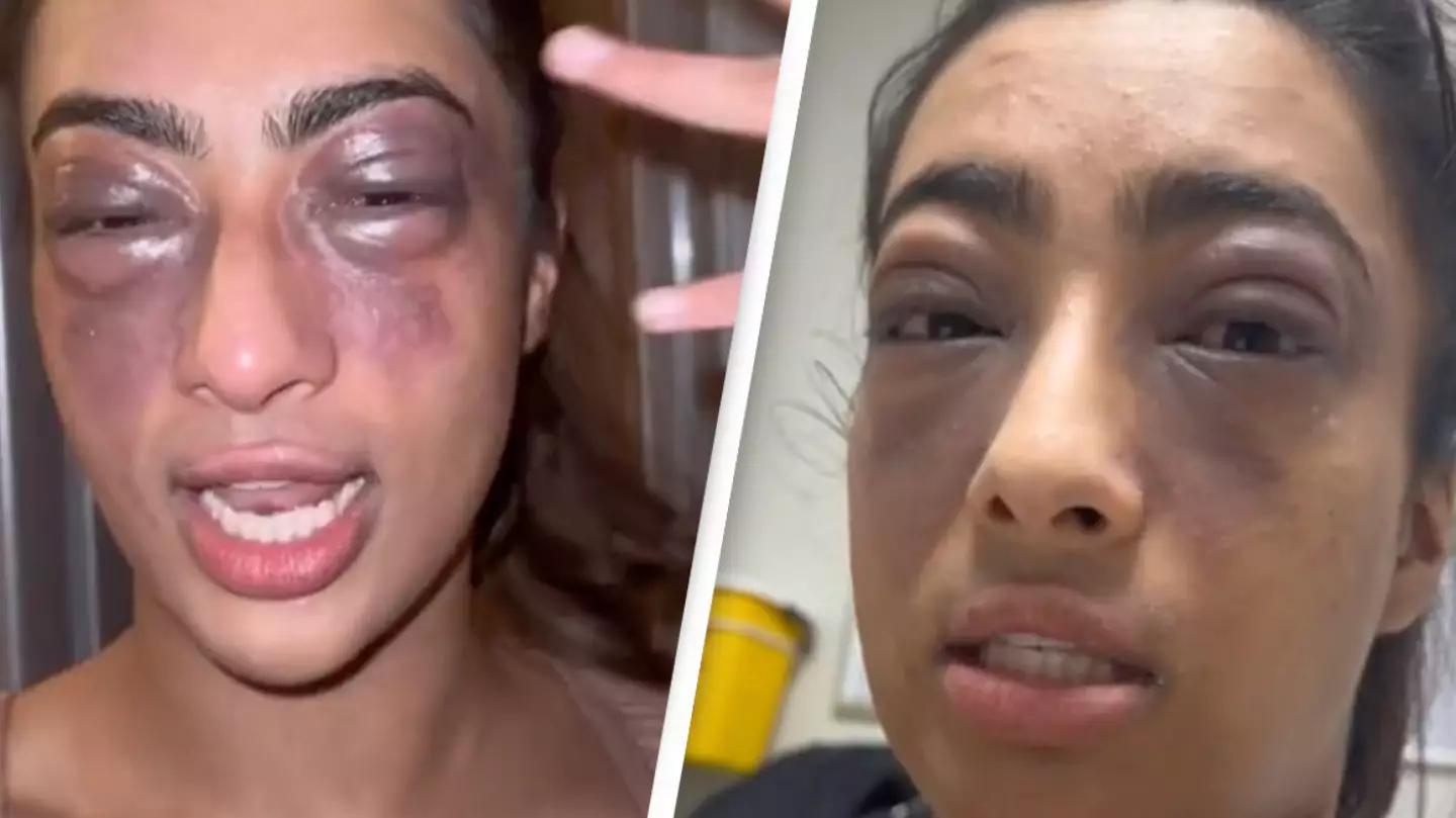 Woman documents the effect of an allergic reaction and the results horrify people