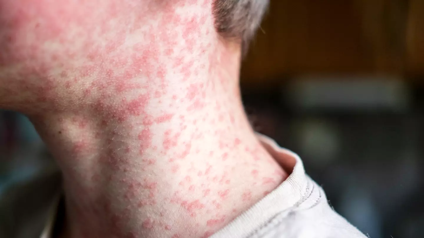 Everything to know about US measles outbreak as 2025 cases so far surpass numbers for whole of 2024