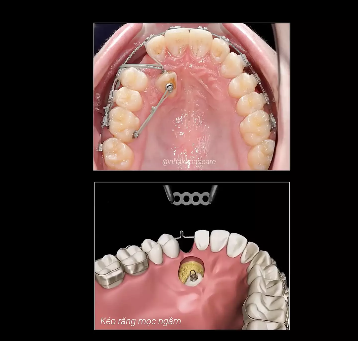Social media users have begun cringing after watching a video showing how braces force teeth into place.