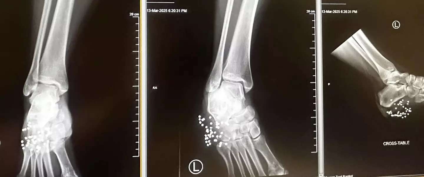 40 pellets went into the mom's foot (Kennedy News and Media)