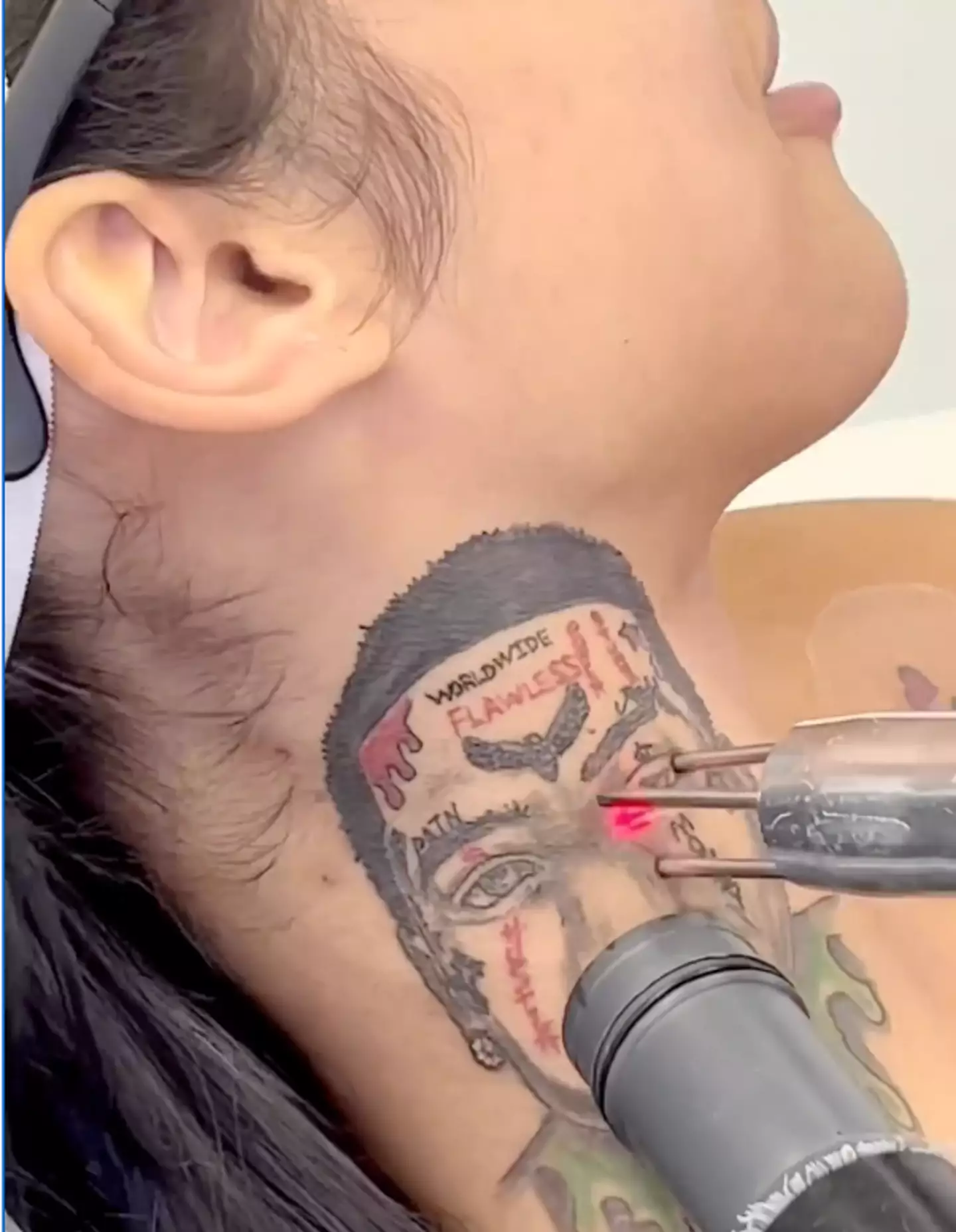 Amina was seen getting her tattoo of Franky removed.