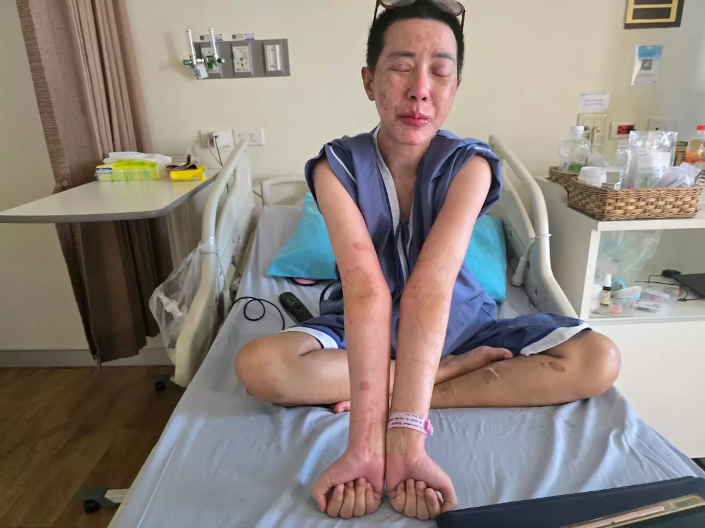 The model was diagnosed with Stevens-Johnson syndrome (Viral Press)