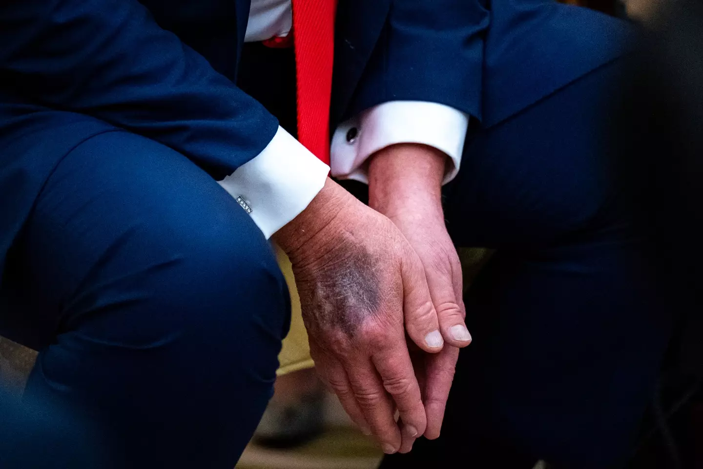 Trump's bruised hands repeatedly sparked concerns over his health (Al Drago/Bloomberg via Getty Images)