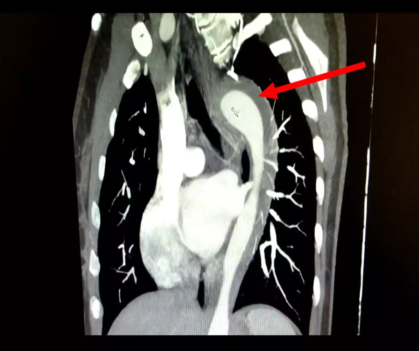 This scan of the chest shows how the leaking aorta has affected the body.