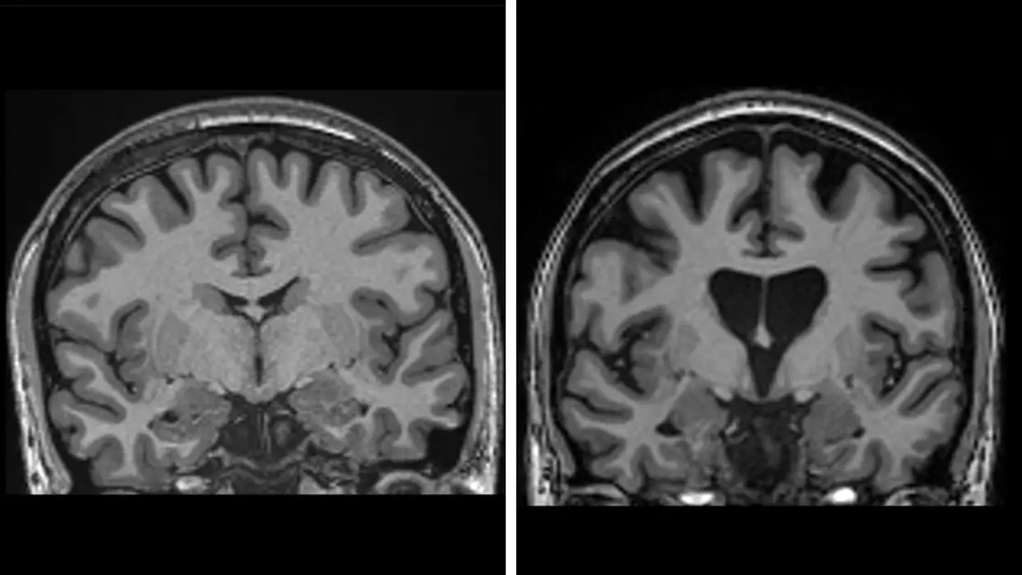 Side-by-side brain scans: left healthy, right shows brain matter loss from neuron death in Huntington’s disease (UCLH)