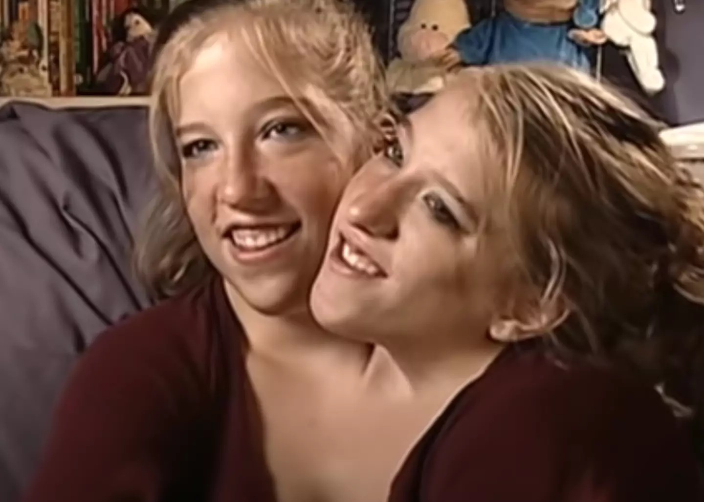 Brittany and Abby share one body.