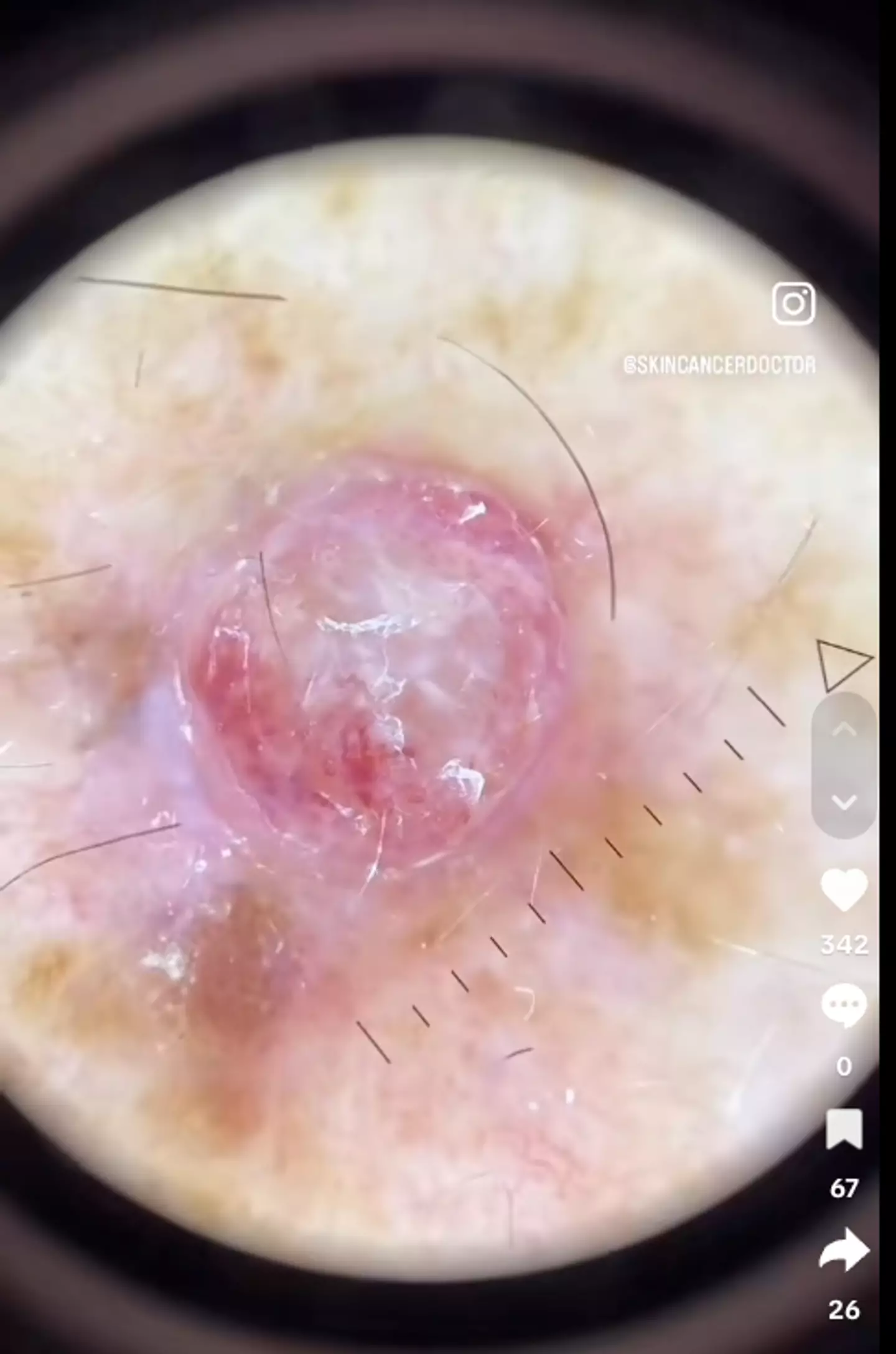 The cancer under the microscope (@skincancerdoctor/TikTok)