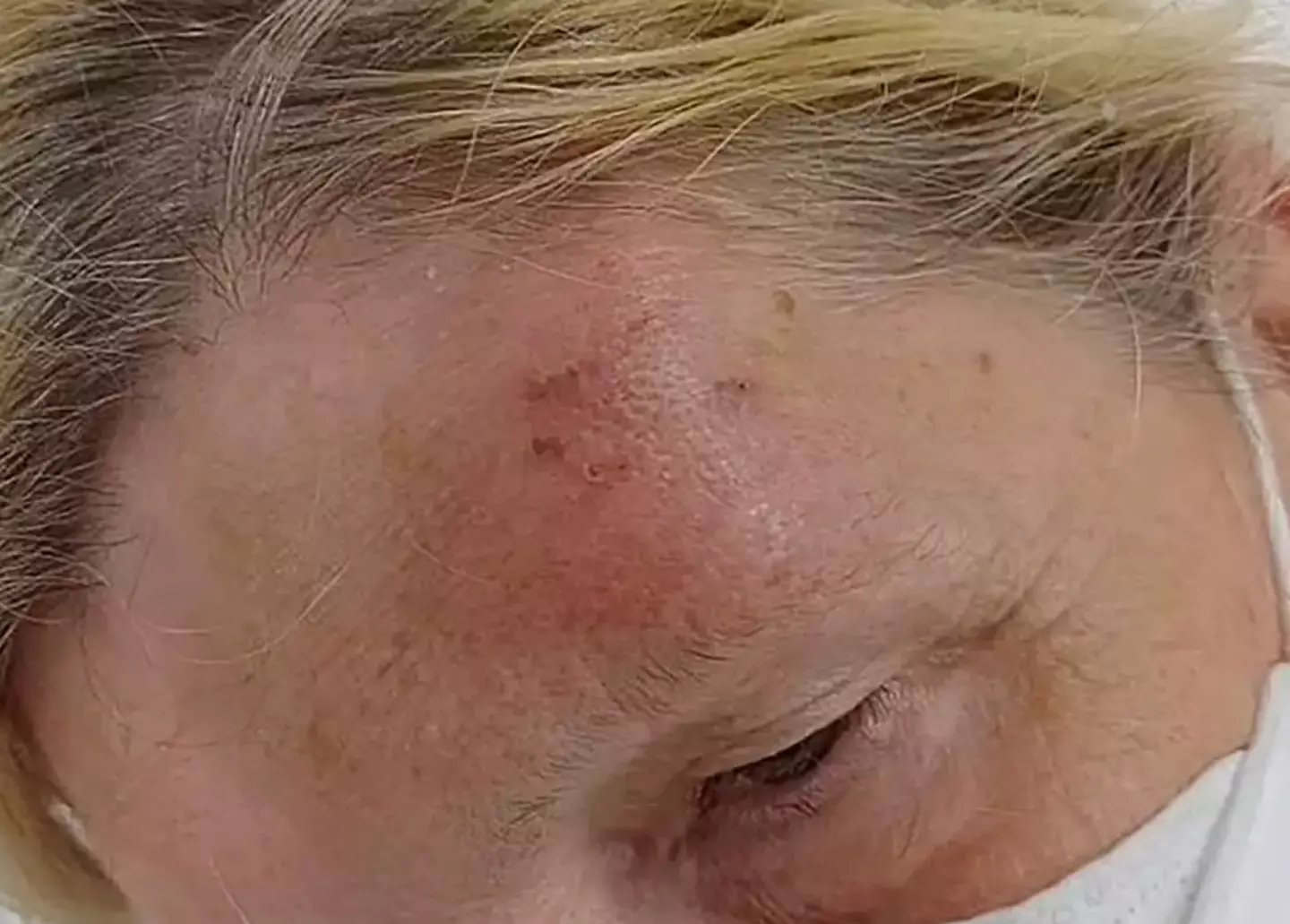 Sandi Galloway didn't want to believe she'd been bitten by a bat.