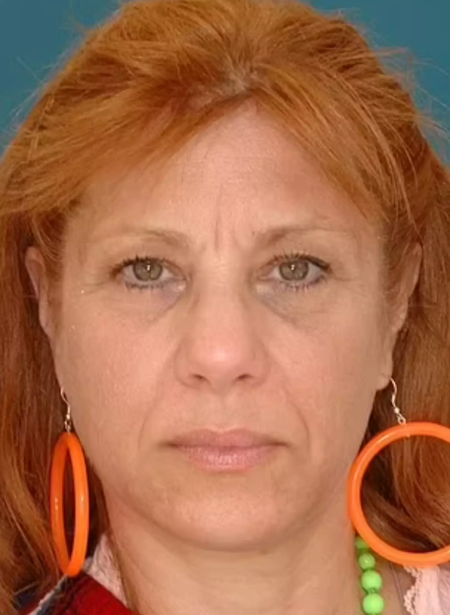 Jean went through a divorce after 27 years of marriage and had darker bags under her eyes and more prominent wrinkles compared to her twin sister Janet (Dr. Bahman Guyuron / American Society of Plastic Surgeons)