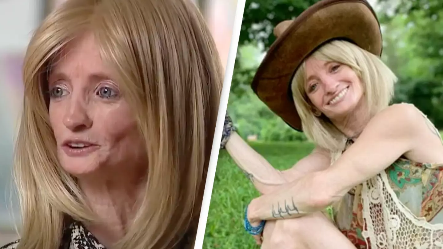 Woman, 46, with rare 'Benjamin Button' condition ages eight times faster than normal