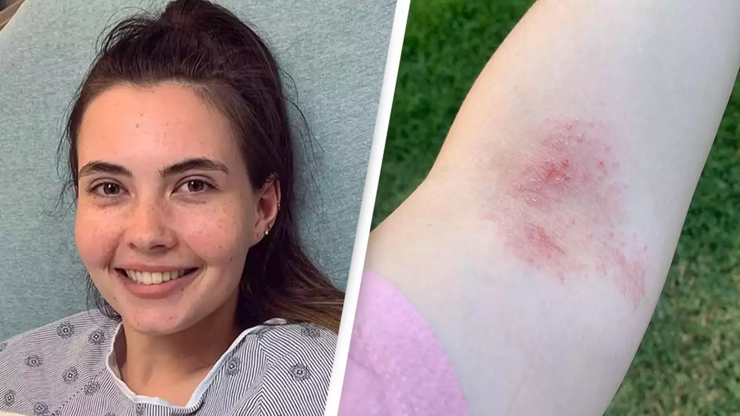 Woman who is allergic to water says her 'scalp would be bleeding' after showering