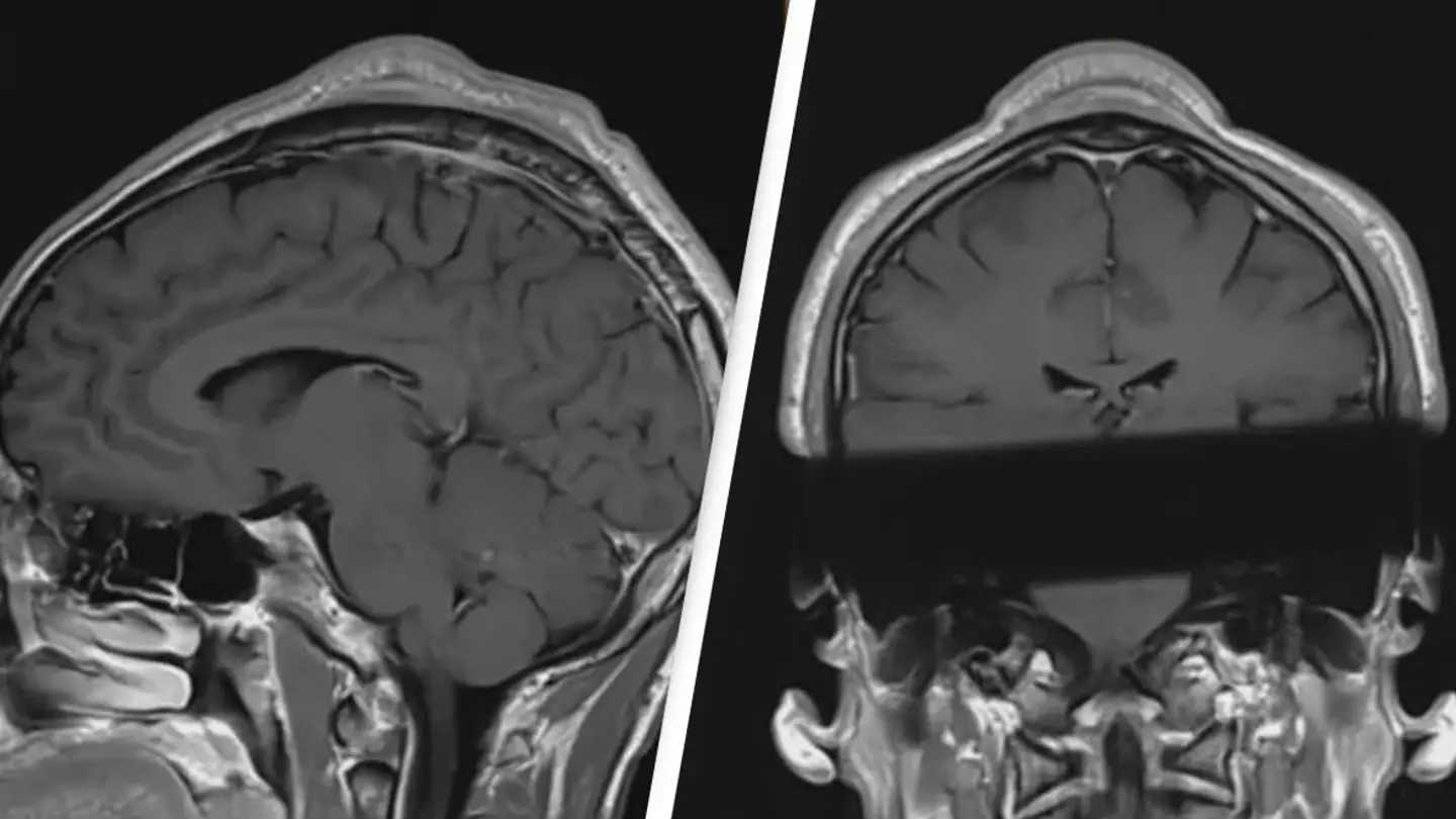 Man's terrifying head scan shows 'tumor' he got from doing common dance move