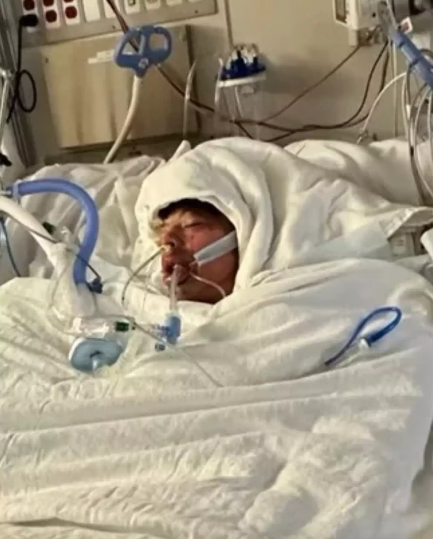 Mason Dark was rushed to the UNC Burn Center in Chapel Hill, after trying out a TikTok challenge that involved spraying a highly inflammable paint aerosol into a lighter.