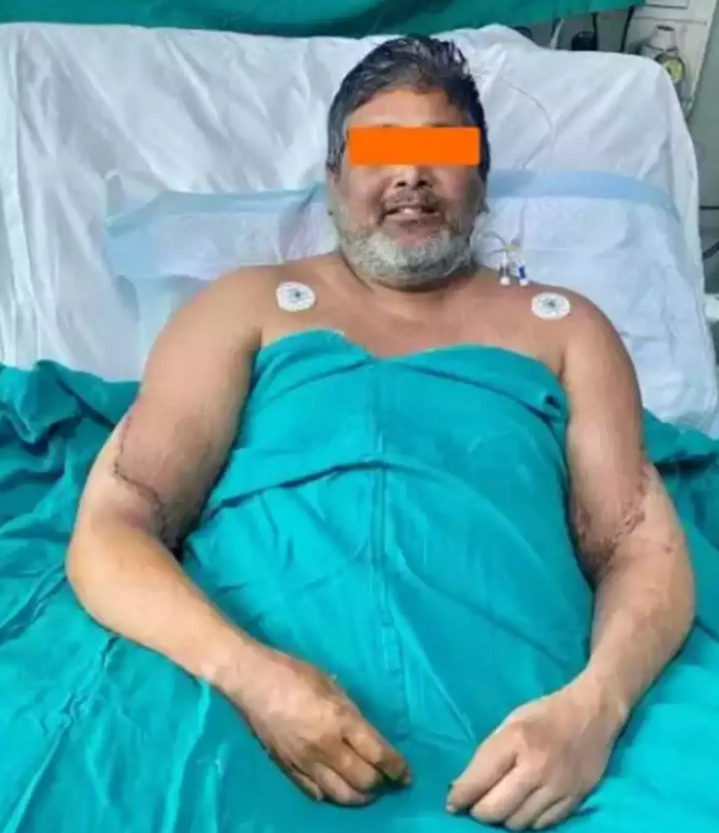 Raj Kumar has been recovering in hopsital for 6 weeks.