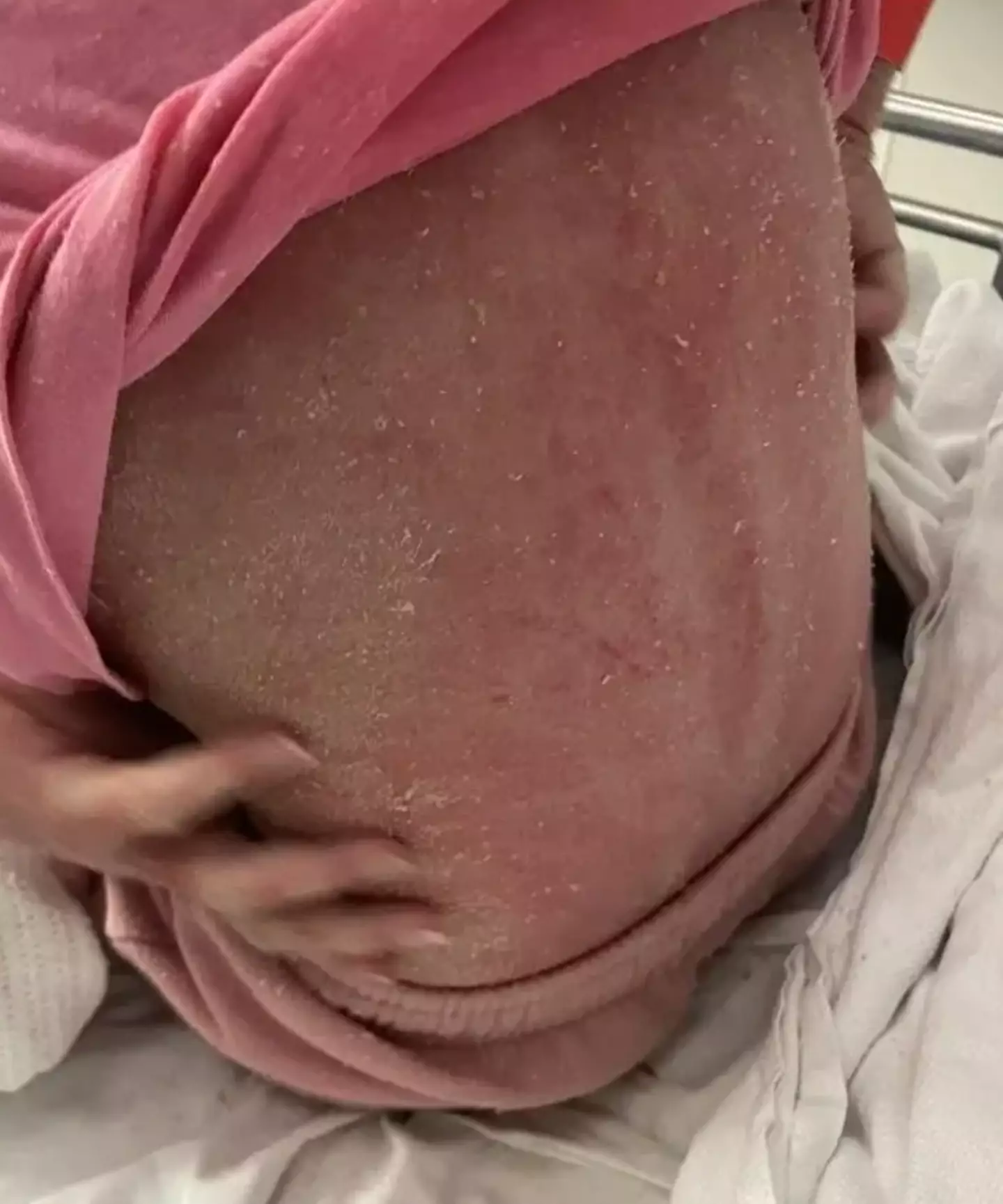 The condition makes her skin shed.