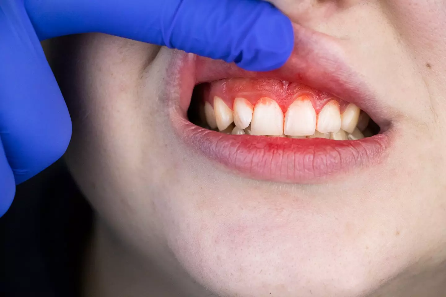 Scurvy can cause someone's gums to bleed (Getty Stock)