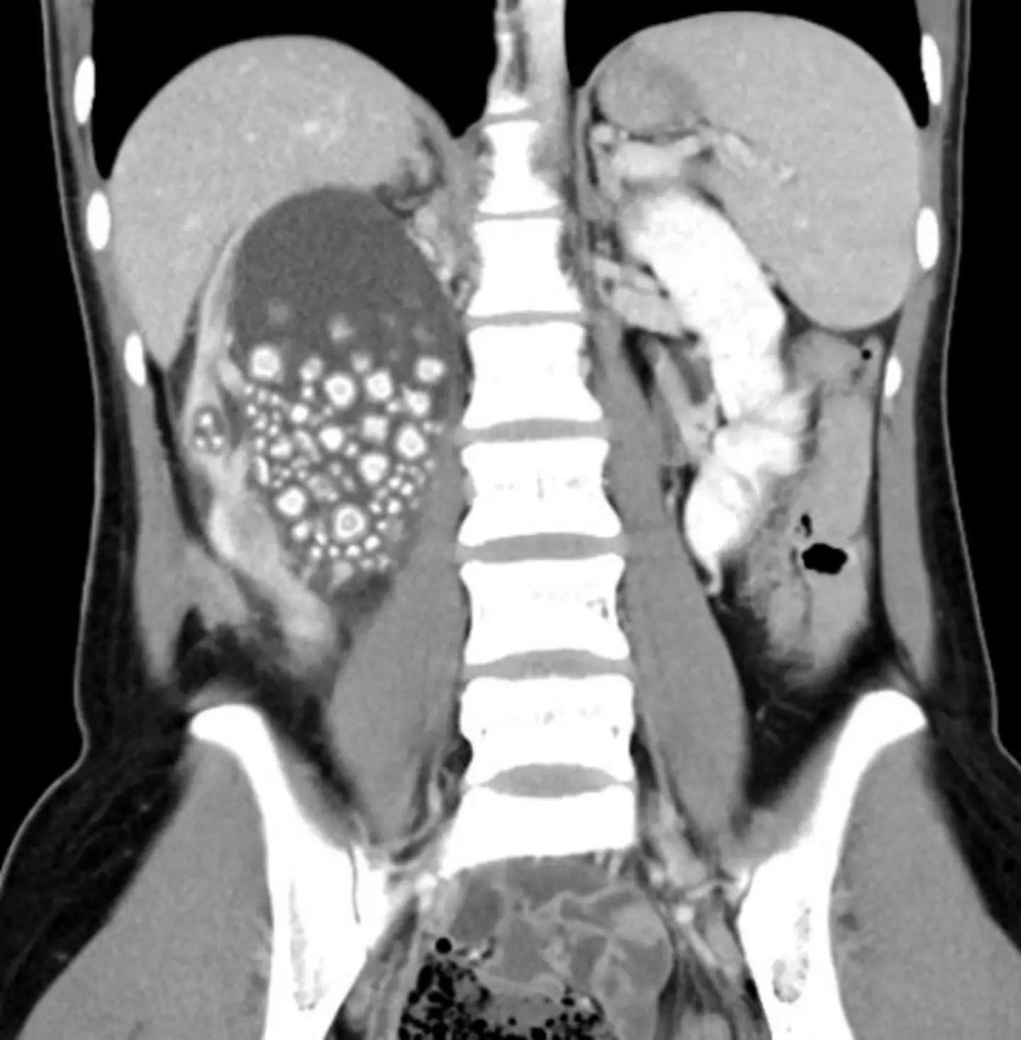 Xiao-yu had hundreds of kidney stones inside her when she visited the hospital (Chi Mei Medical Center)