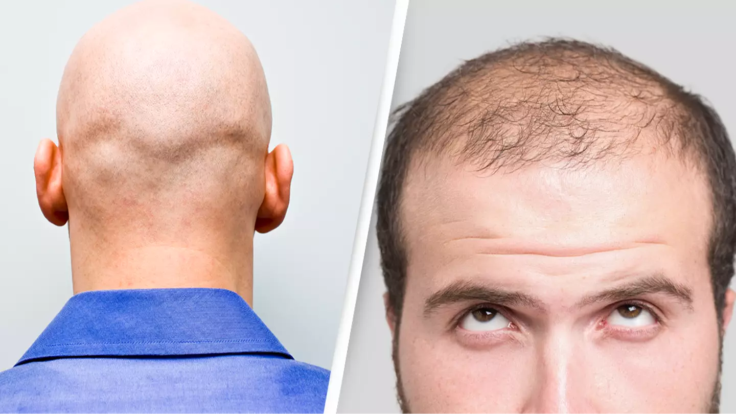 Important reason why men are far more likely to go bald than women