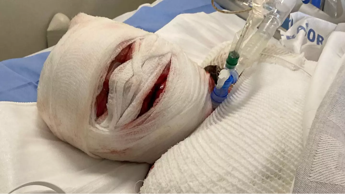 How woman's face 'fell off' following rare reaction to Ibuprofen that left her in a coma