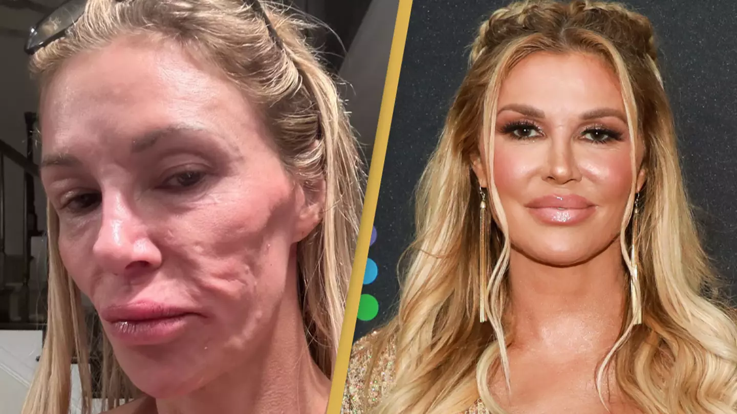 Parasite ‘having babies’ in Brandi Glanville’s face has caused her to lose 5 teeth and $70,000