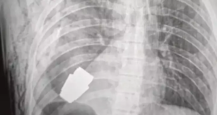 In 2023, a Ukrainian soldier survived after a grenade became lodged in his chest (Facebook/Ukraine Medical Force Command)