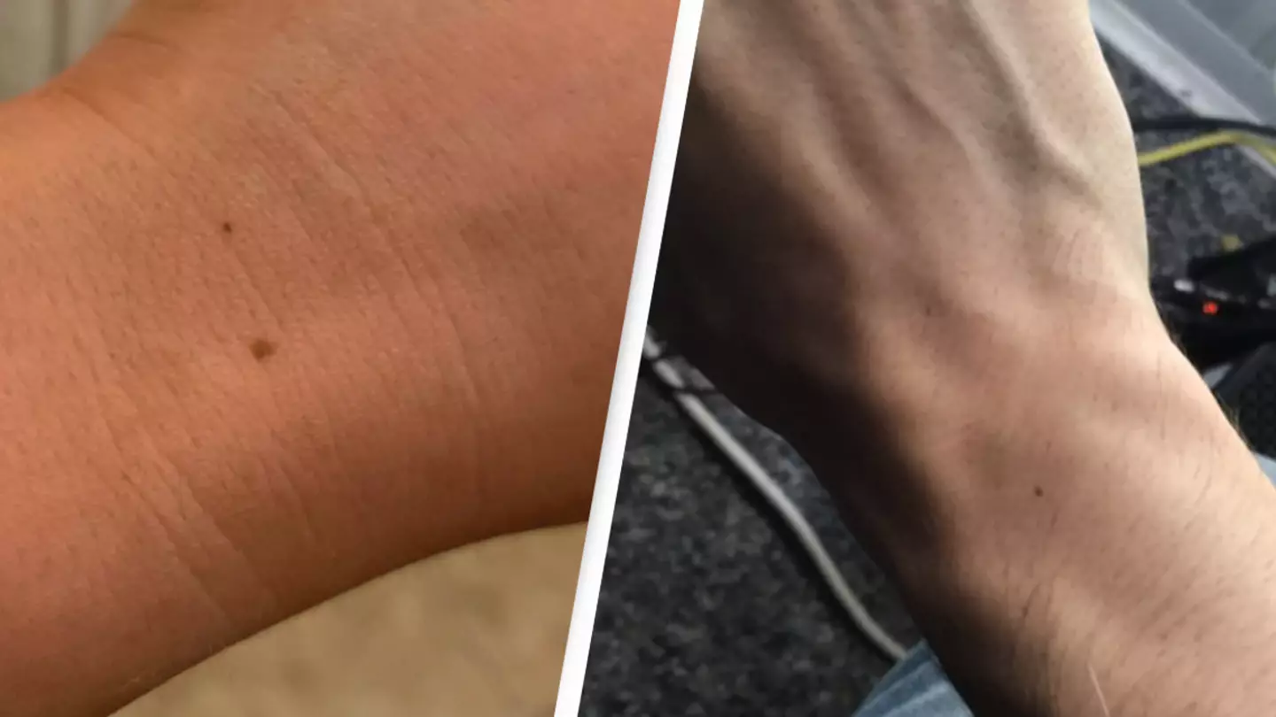 Doctor explains why so many people have the exact same freckle in the same place