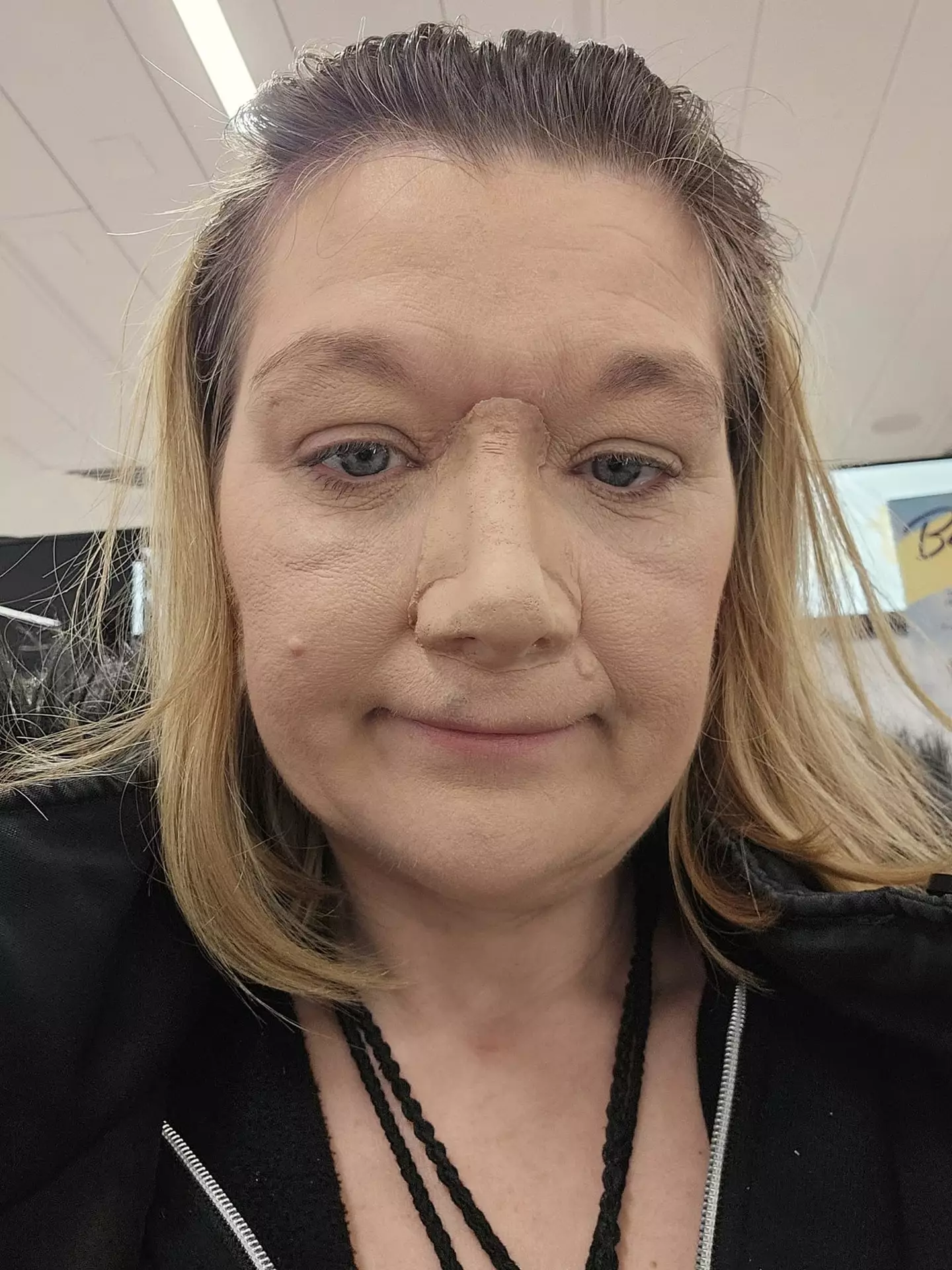 Ellen was left with no nose (Kennedy News and Media)