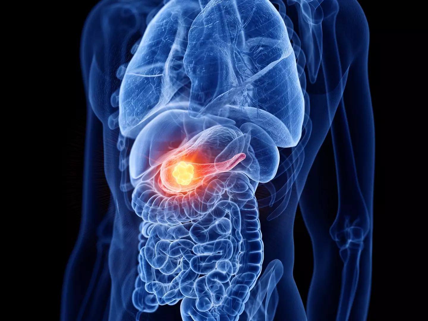 Pancreatic cancer is one of the most common cancers in the United States (Getty Stock)