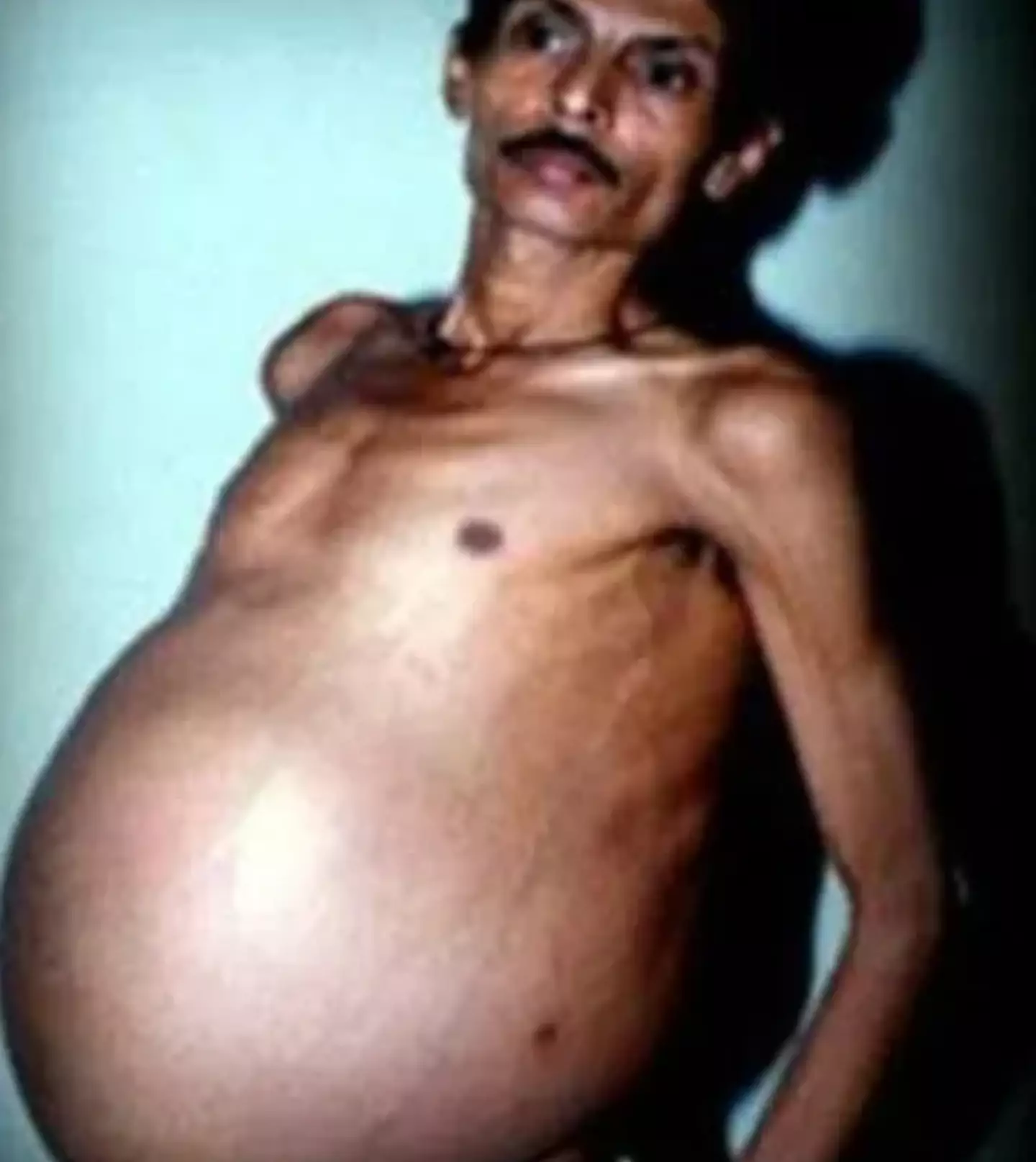Bhagat's twin had been living off the contents of his stomach as a 'parasite'.