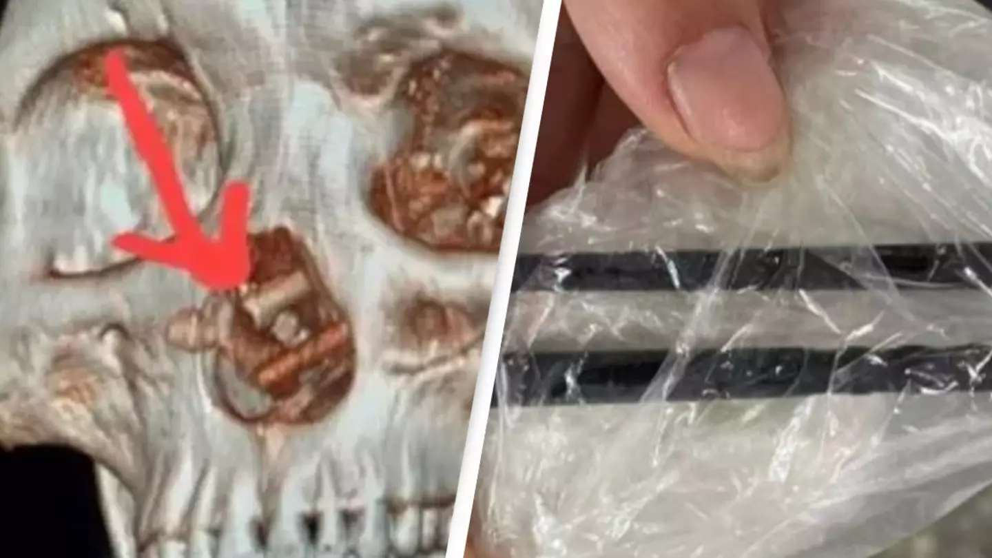 Man suffering from headaches for nearly half a year discovers he has chopsticks lodged in his brain