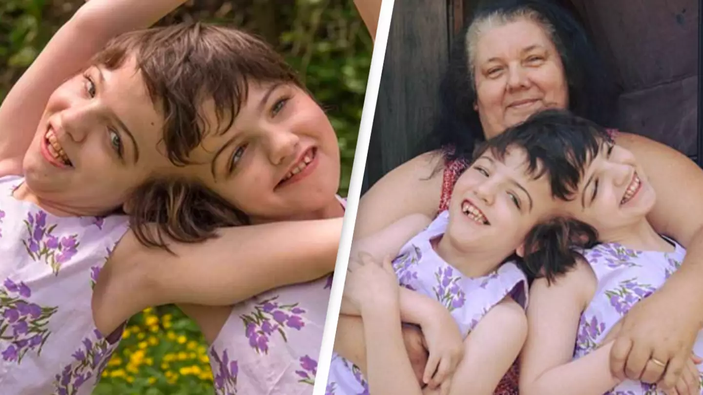Twins who are conjoined at the head can hear each other's thoughts and see through each other's eyes