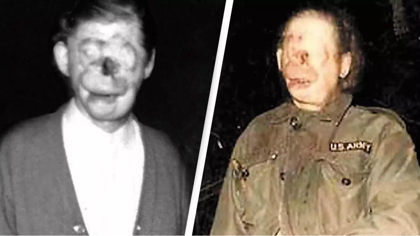Tragic story of a man who became an urban legend after an accident left him with no face