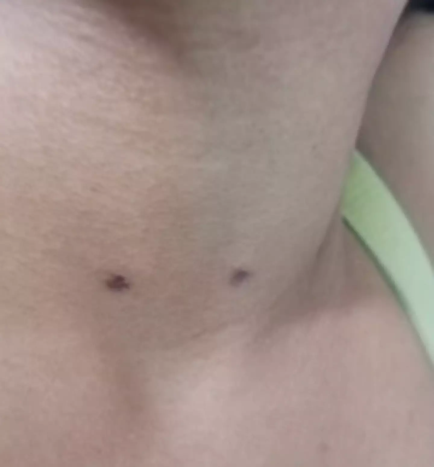 These are her the marks on her daughter's neck.