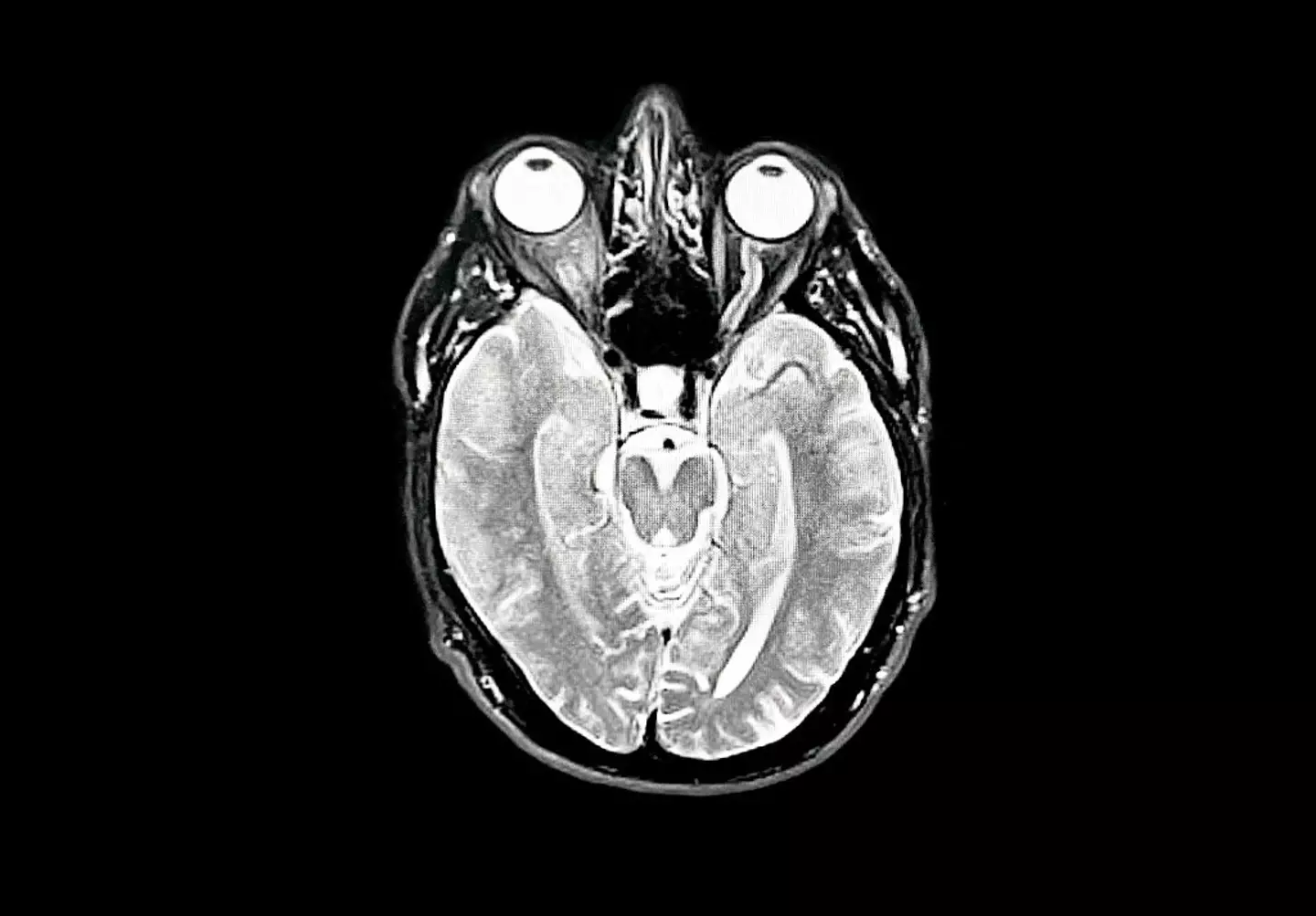 An MRI Scan of a brain showing early Dementia (Peter Dazeley/Getty Images)