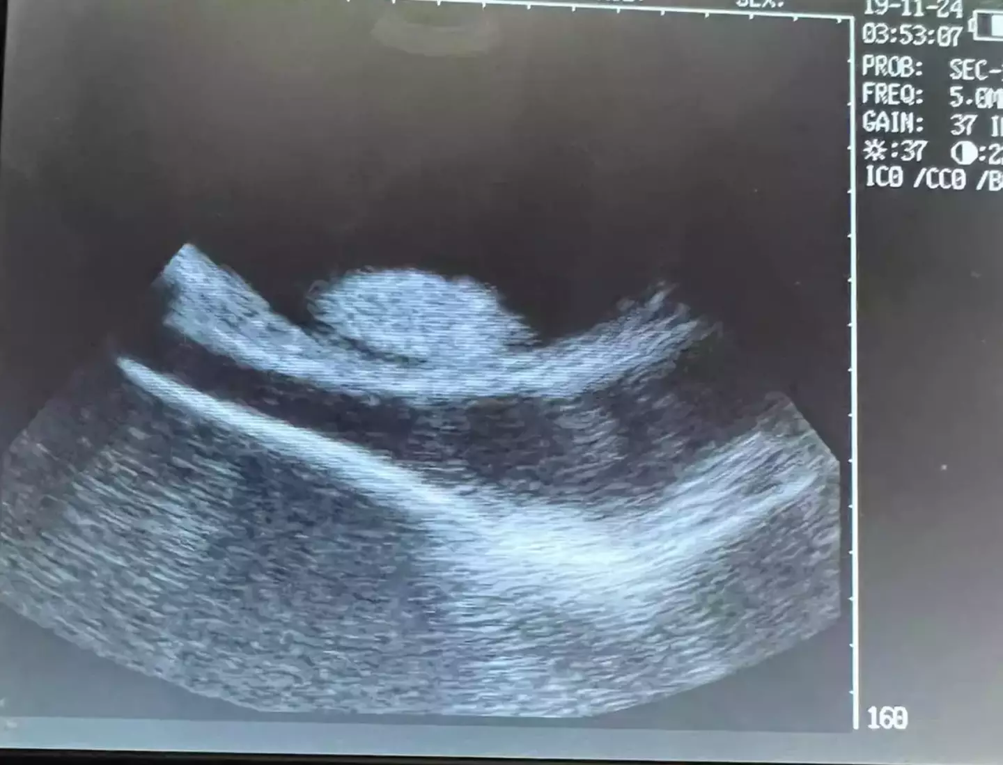 Tests were done to rule out other conditions.