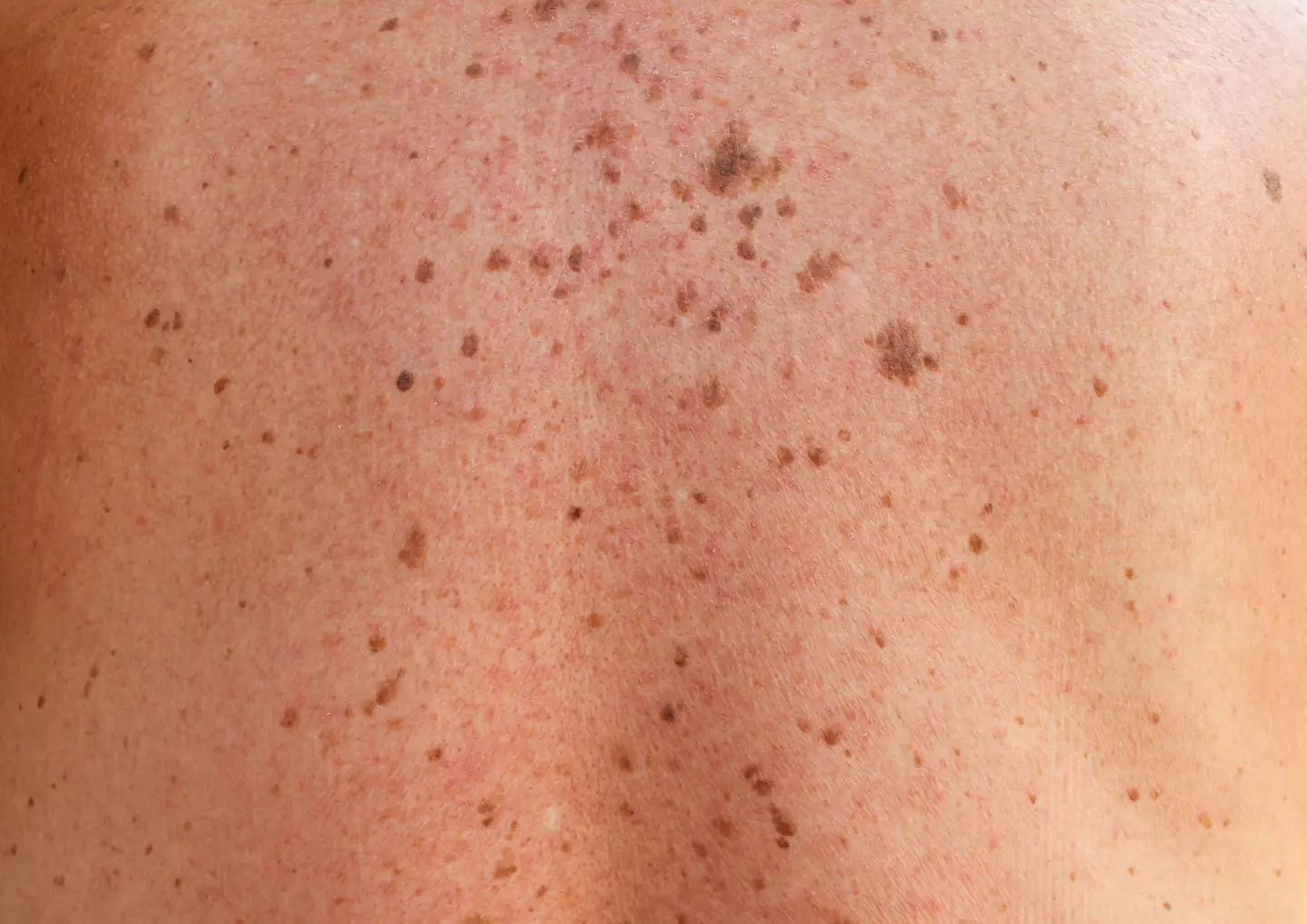 They're hopeful that melanoma could be treated through diet in the future as well.