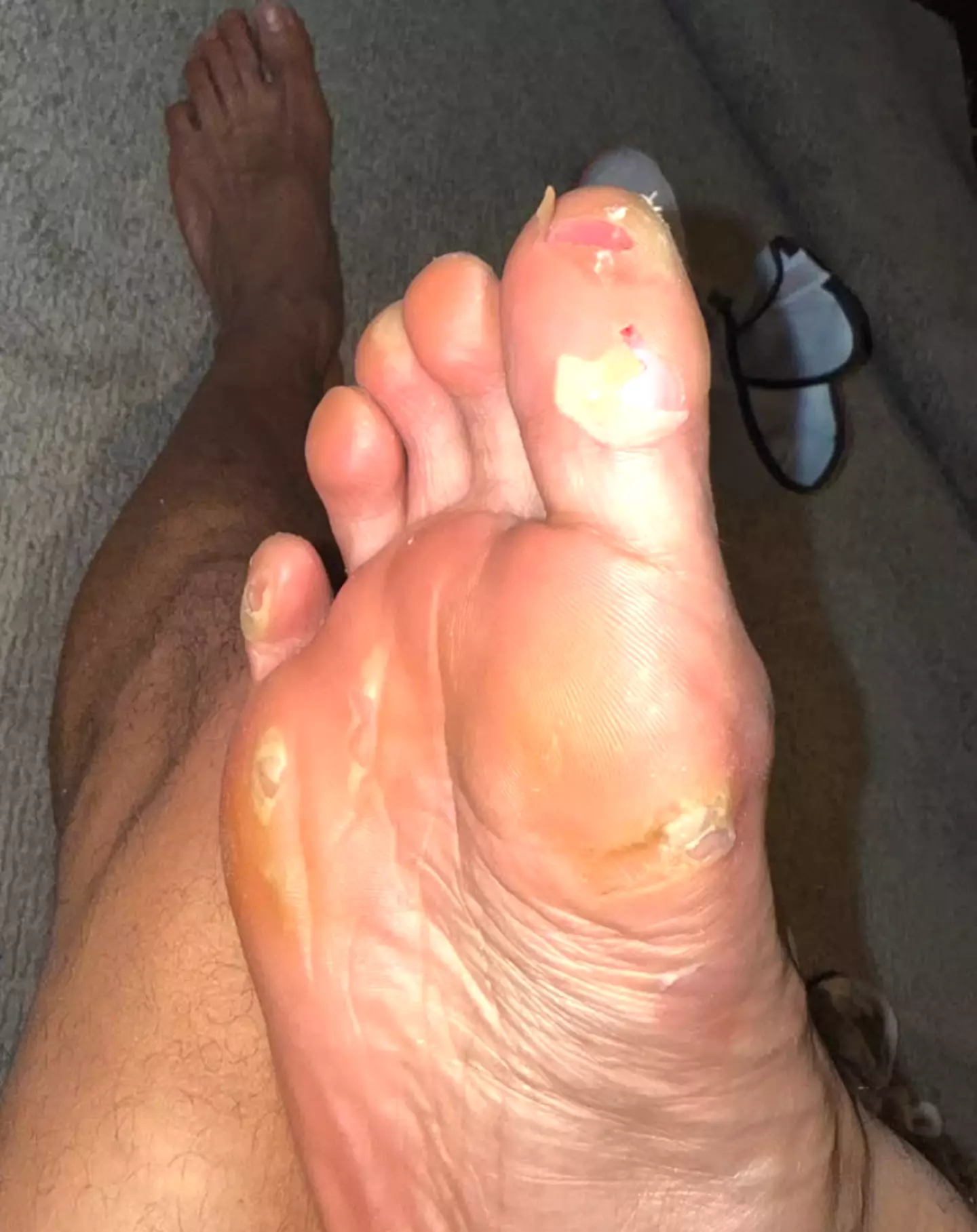 Chris Eubank Jr. took to social media to show off his blisters. Image: Instagram/Chris Eubank Jr.