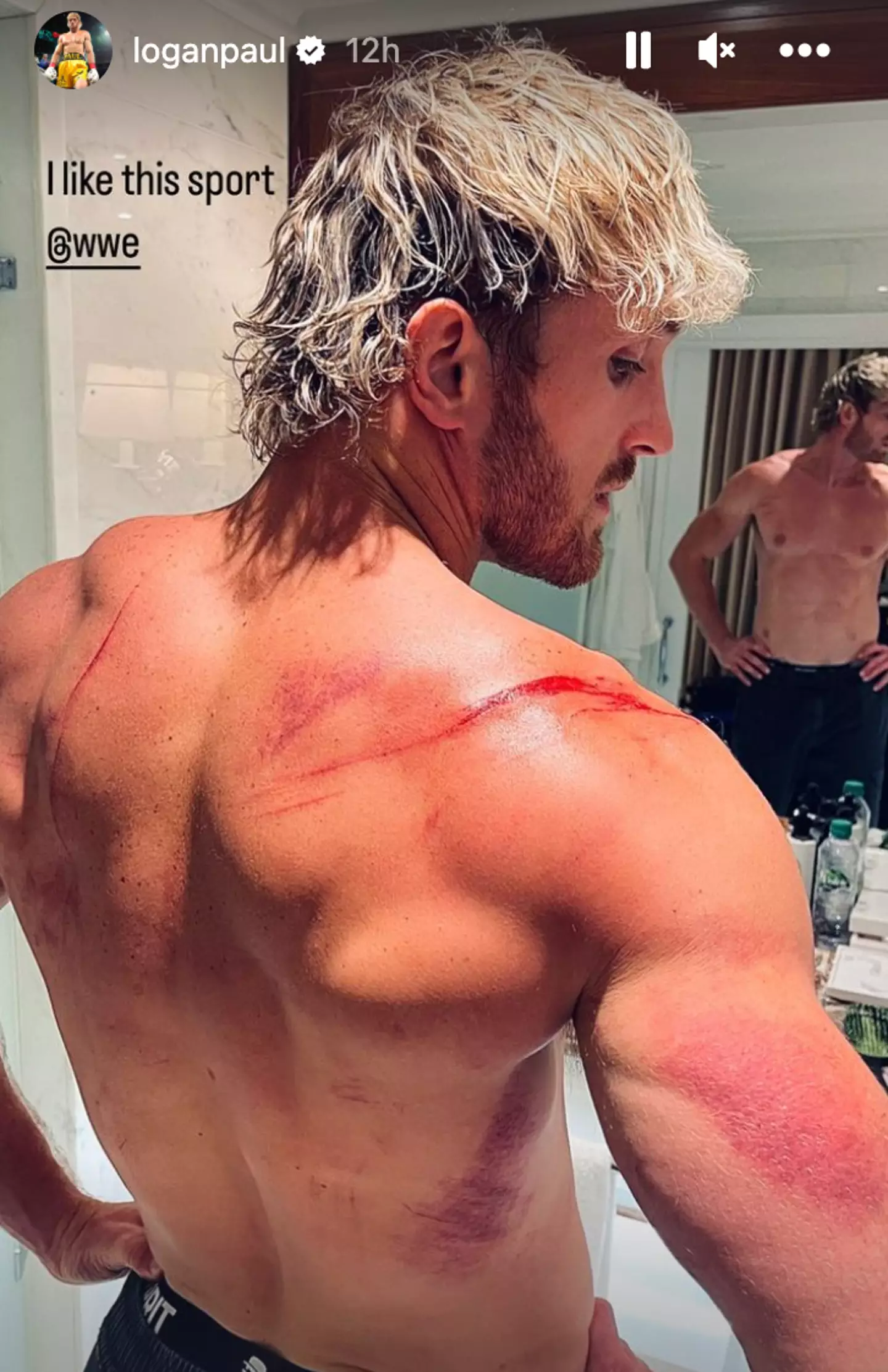 Logan Paul shows off his injuries. Image: Instagram