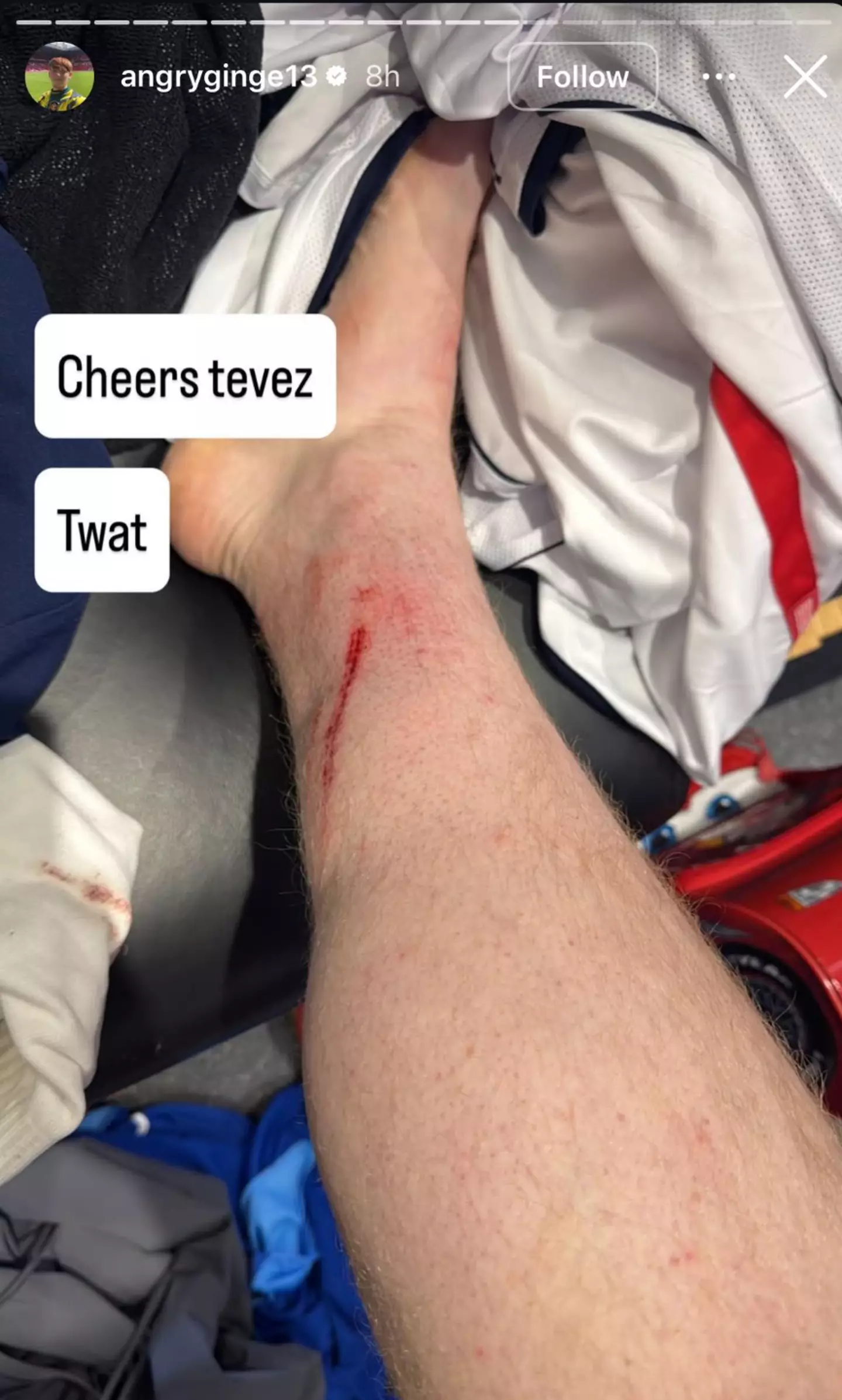 Angry Ginge shows off his wound following Soccer Aid. Image: Instagram/Angry Ginge