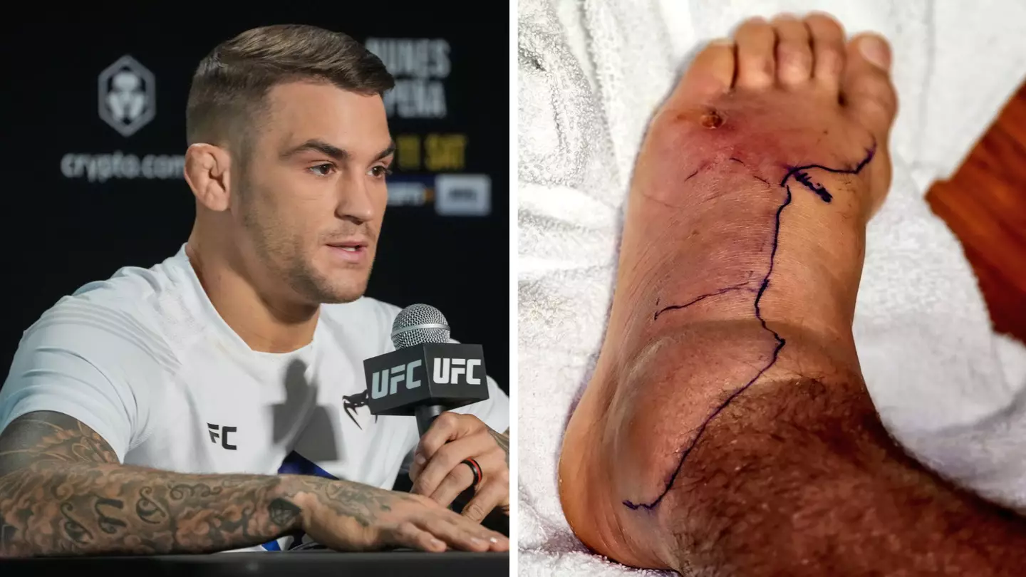 Dustin Poirier shows off gruesome looking foot as he battles infection in hospital