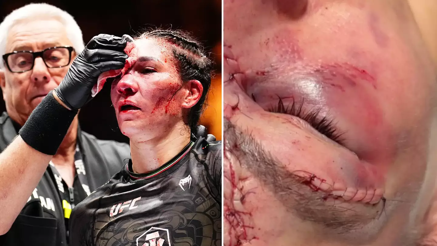 Doctor shares horrific aftermath of 'worst cut in UFC history' suffered by fighter at Noche UFC