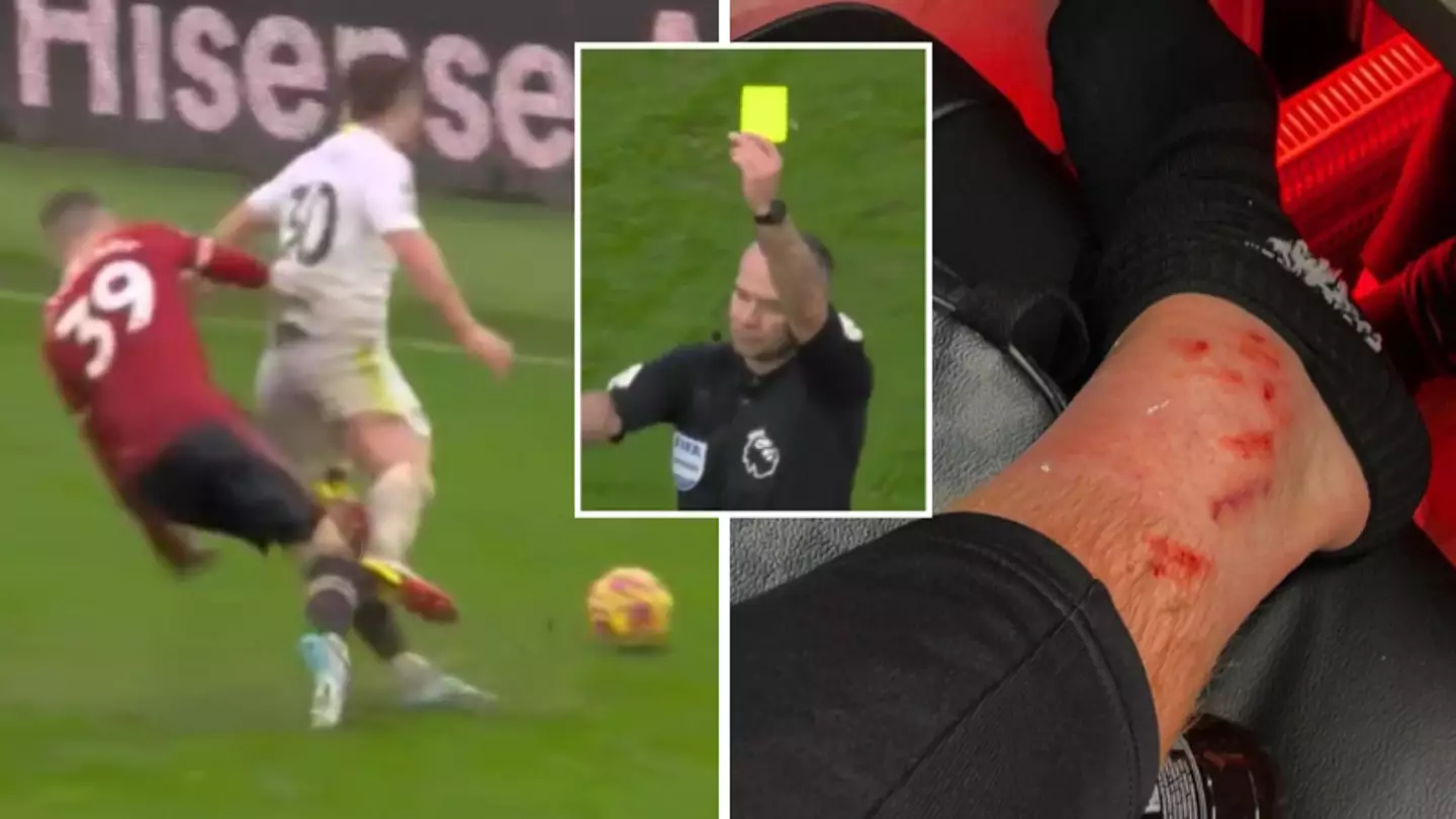 Manchester United's Scott McTominay Shows Off His War Wounds After Hard-Fought Victory Over Leeds United