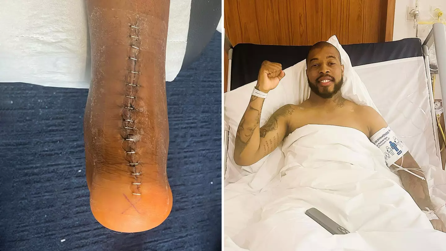 Kimpembe's achilles injury in May last year. Image credit: Instagram/kimpembe3
